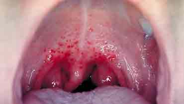 Infectious mononucleosis - Wikipedia
