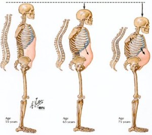Osteoporose/ o que você precisa saber.