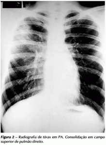 Tuberculose Rx pulmão contaminado